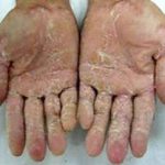 Bệnh viêm da lòng bàn tay, bàn chân tại huyện Ba Tơ – Quảng Ngãi