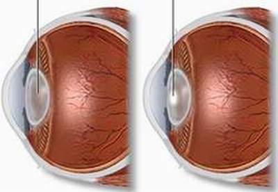 Ðiều cần biết khi mổ đục thể thủy tinh