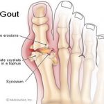 Nguyên nhân bệnh gout – thống phong