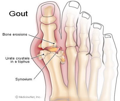 Nguyên nhân bệnh gout – thống phong
